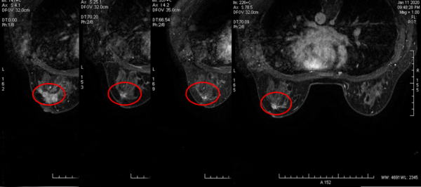 愈見未萊 | 恩美曲妥珠單抗助力HER2+早期乳腺癌患者的生存率再上新臺階