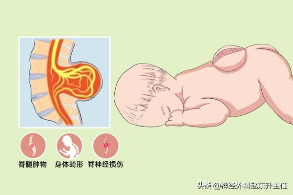 脊柱裂是什麼病？大小便障礙該怎麼治療？