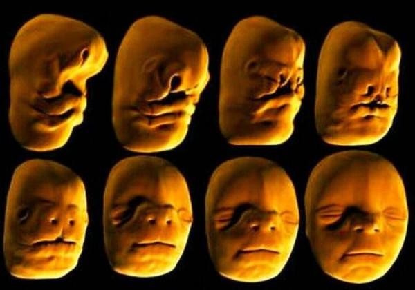 寶寶是一隻“小兔子”，還沒長牙就要開始正畸了