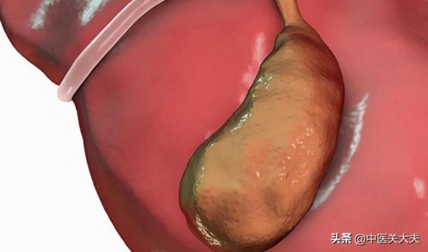 一位膽囊息肉患者的好訊息