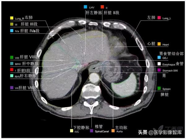 CT斷層解剖圖譜最全總結「推薦收藏」 CT斷層解剖圖譜最全總結「推薦收藏」