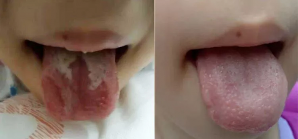 地圖舌背後的慘痛經歷！沒有自以為是的愛，就沒有傷害