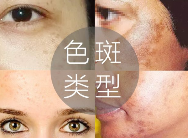 色斑根源為血瘀肌膚，祛斑先祛瘀，內調外敷，食療輔助，瘀散斑退