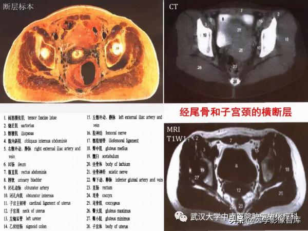 CT斷層解剖圖譜最全總結「推薦收藏」 CT斷層解剖圖譜最全總結「推薦收藏」