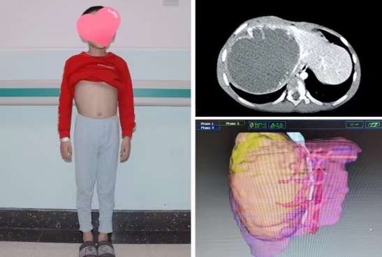 7歲男孩近3斤大巨大腫瘤!神奇摘除 7歲男孩近3斤大巨大腫瘤!神奇摘除