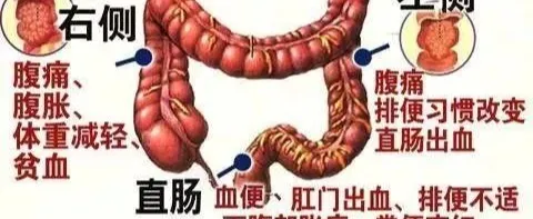 這樣的大便，可能預示著大腸癌上身