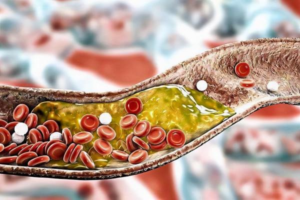 膽固醇高不是小事，堅持4個好習慣，輕鬆降低膽固醇