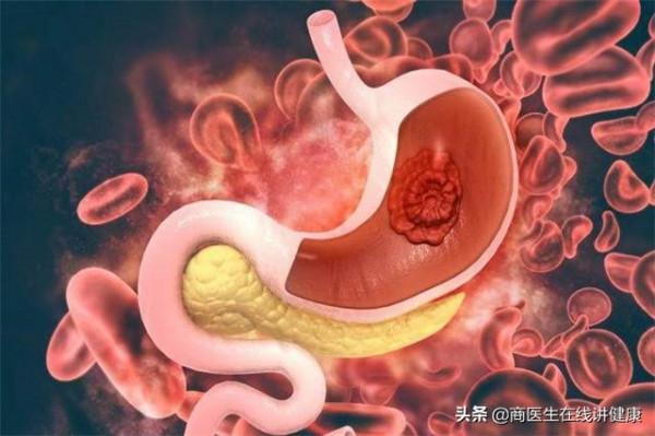 燒心反酸胃難受怎麼辦？醫生：用這2個方法可以得到緩解