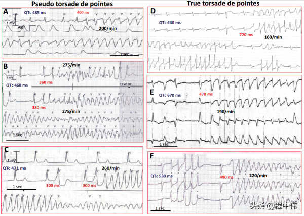 真假Tdp鑑別：偶聯間期