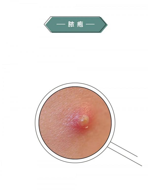 漫畫科普：“揹負”太多，“疹”的很累！