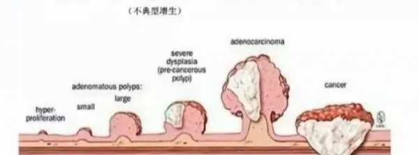 這樣的大便，可能預示著大腸癌上身