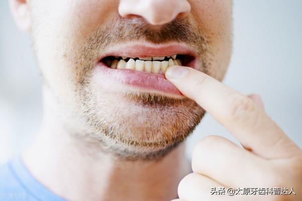 洗牙和牙周刮治有什麼區別呢？