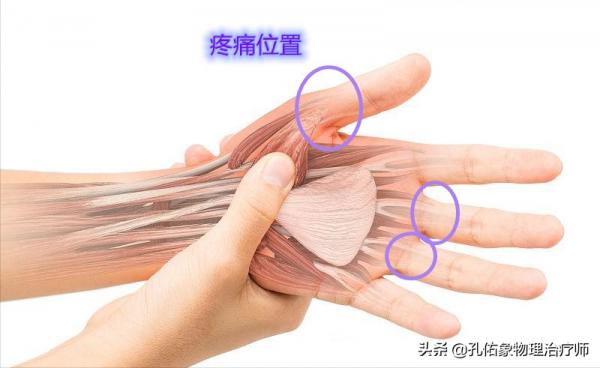 50歲左右的中老年人，手指僵硬、疼痛、怕冷、變形，預示哪些疾病