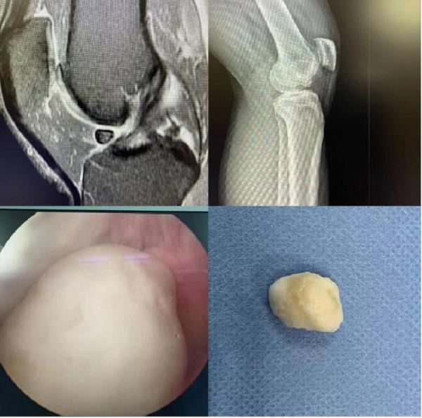 膝關節痛,原來是關節有個“小老鼠” 膝關節痛,原來是關節有個“小老鼠”