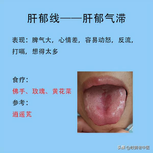 常見六種失眠的舌象，以及解決方法分享，這時候能睡個好覺了