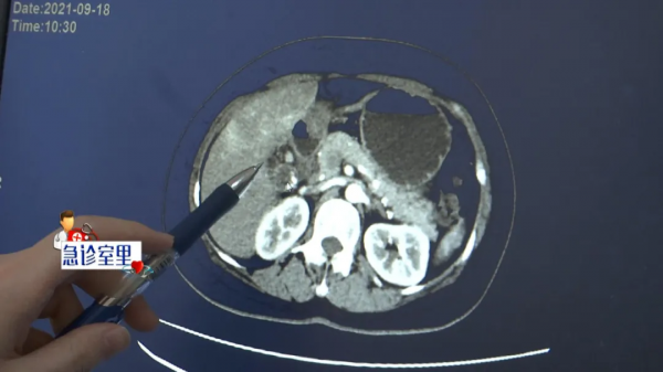 女子患膽結石未引起重視,竟發展成膽囊癌 女子患膽結石未引起重視,竟發展成膽囊癌