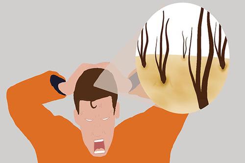 頭蟎是頭皮、頭髮損傷的重要原因，保護頭皮要從消除頭蟎開始
