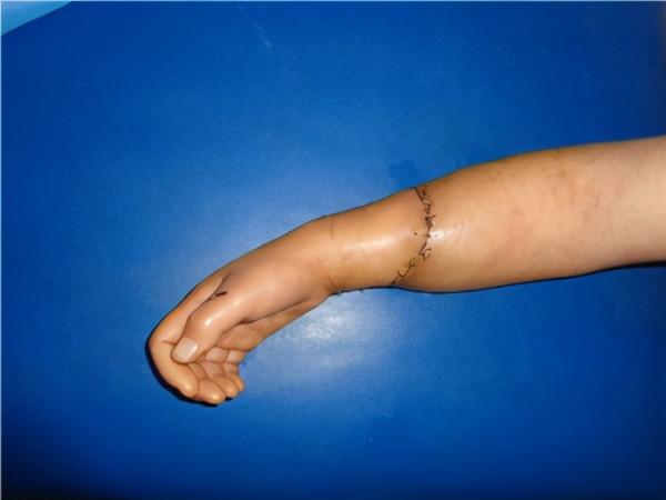 離家出走的斷肢，還能再找回來嗎？