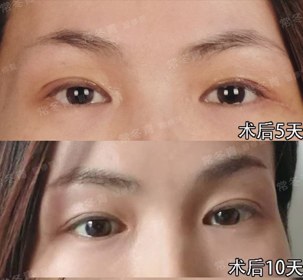 雙眼皮修復 | 常見的3種需要修復情況:寬假深、上瞼凹陷,不對稱 雙眼皮修復 | 常見的3種需要修復情況:寬假深、上瞼凹陷,不對稱