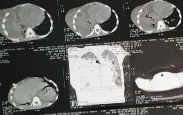 9歲聾啞女孩胸壁破潰流膿！誰之過？什麼原因造成？該如何避免？