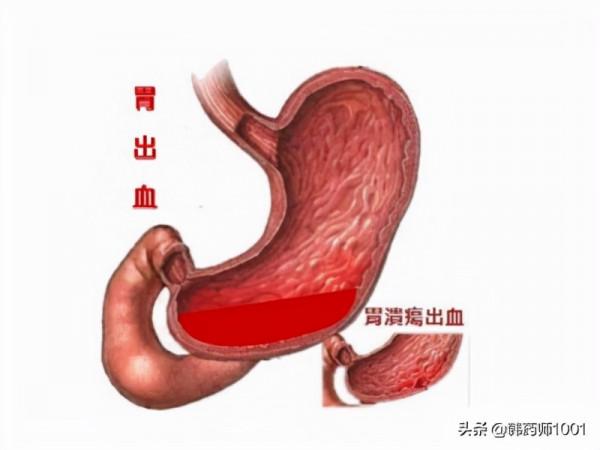 布洛芬，雙氯芬酸等非甾體類抗炎止痛藥有什麼副作用？