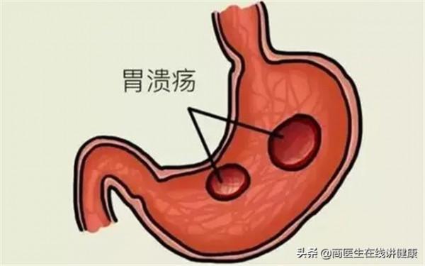 燒心反酸胃難受怎麼辦？醫生：用這2個方法可以得到緩解