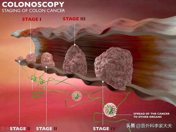 結腸癌三期能治好嗎? 結腸癌三期能治好嗎?