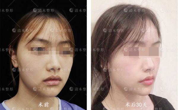 嘴角上揚＋M唇 | 30天效果對比