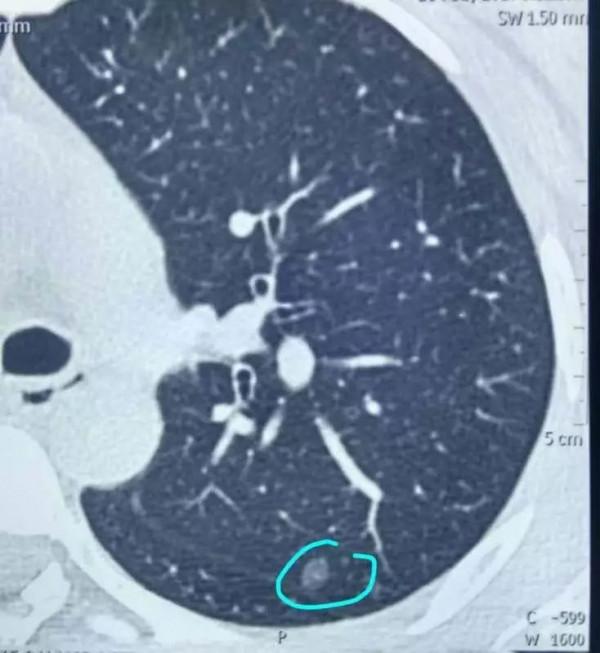 不抽菸居然也查出了肺小結節?專家這麼說 不抽菸居然也查出了肺小結節?專家這麼說