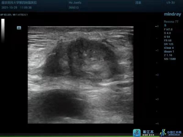 新技術 新應用丨腹壁轉移癌微波消融治療