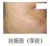 祛斑攻略——常見色斑形成原因和護理方法 祛斑攻略——常見色斑形成原因和護理方法