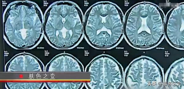 真實故事:山西45歲女子一夜變黑,體重急速增加,手術後讓家人落淚