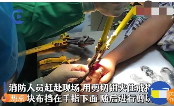 女子戴九枚戒指，結果戒指卡住取不出來，手指已經嚴重膿化
