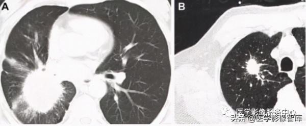 22個肺部疾病的CT徵象 22個肺部疾病的CT徵象