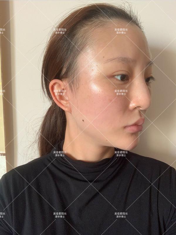 32歲公開做小拉皮+頸闊肌成形手術全過程,速來圍觀 32歲公開做小拉皮+頸闊肌成形手術全過程,速來圍觀