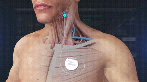 迷走神經電刺激（VNS）改善了孩子的癲癇發作