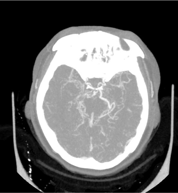 腦動靜脈畸形影像學特徵
