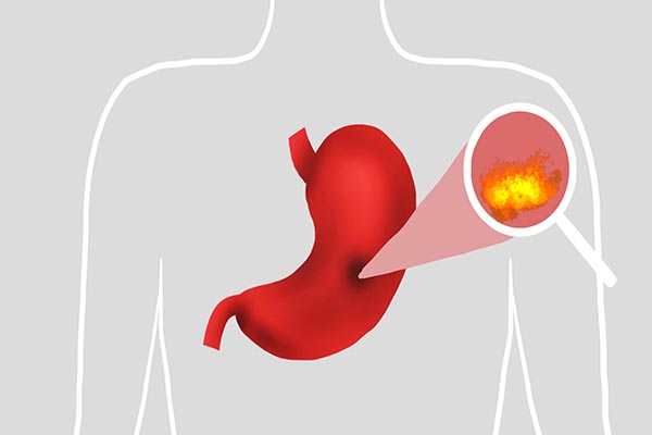 胃病“三分治七分養”，養護腸胃記住“4不要”，早學早受益