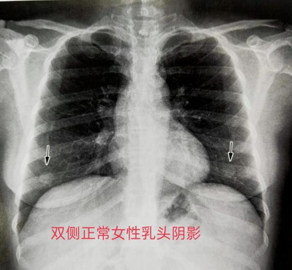 學習《X線讀片指南》之呼吸系統