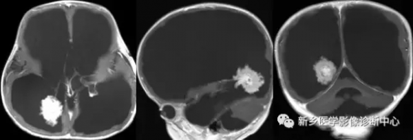 在側腦室三角區看到佔位，要想到這8種腫瘤