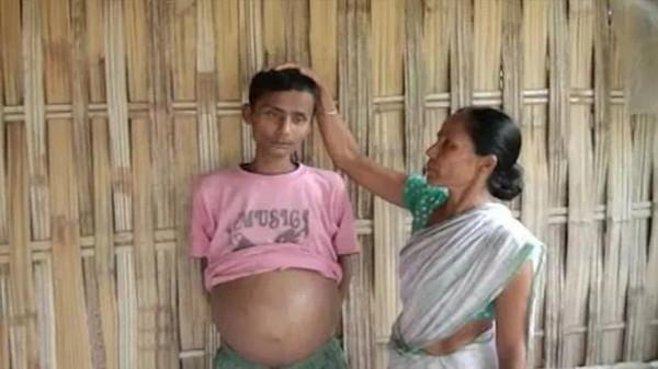 2012年男孩肚子越漲越大，每天只能睡1小時，後來怎麼樣了？