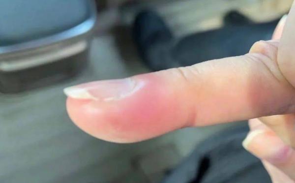 手上長不完的倒刺,真的是缺維生素嗎?教你3招,輕鬆去除倒刺 手上長不完的倒刺,真的是缺維生素嗎?教你3招,輕鬆去除倒刺