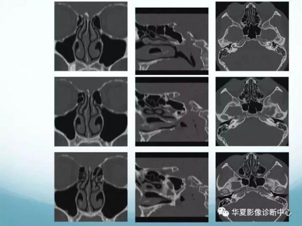 頭頸五官CT斷層解剖圖及常見病影像診斷