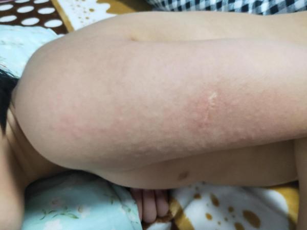 6歲寶寶接種新冠疫苗後