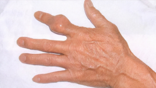 痛風不痛就是病好了嗎？這3個降尿酸的方法，可能比吃藥都有效