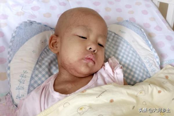 2歲女孩頻繁發燒,病因是體內缺一種細胞,目前已花百萬元治療費 2歲女孩頻繁發燒,病因是體內缺一種細胞,目前已花百萬元治療費