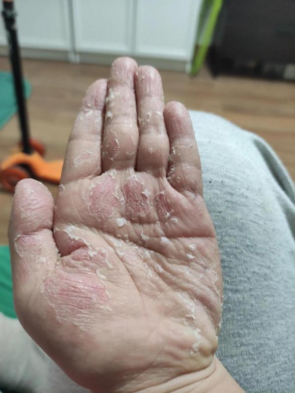 娃的手脫皮好嚴重 娃的手脫皮好嚴重