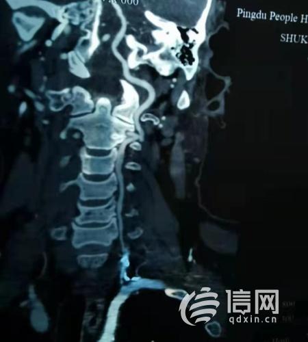 醫護人員妙手再通 平度市人民醫院血管內介入再上新高度 醫護人員妙手再通 平度市人民醫院血管內介入再上新高度