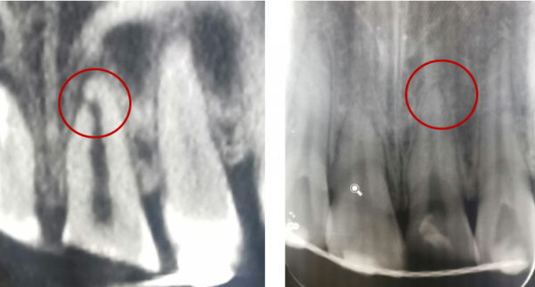 牙齒受了外傷，你知道該怎麼辦嗎？
