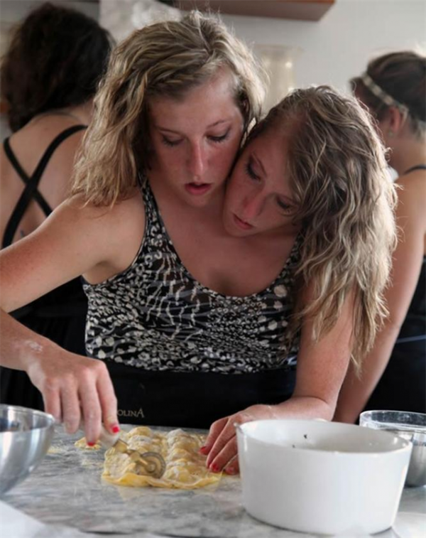 雙胞胎女嬰腹部相連醫生都說活不了，4歲做分離手術如今已滿20歲